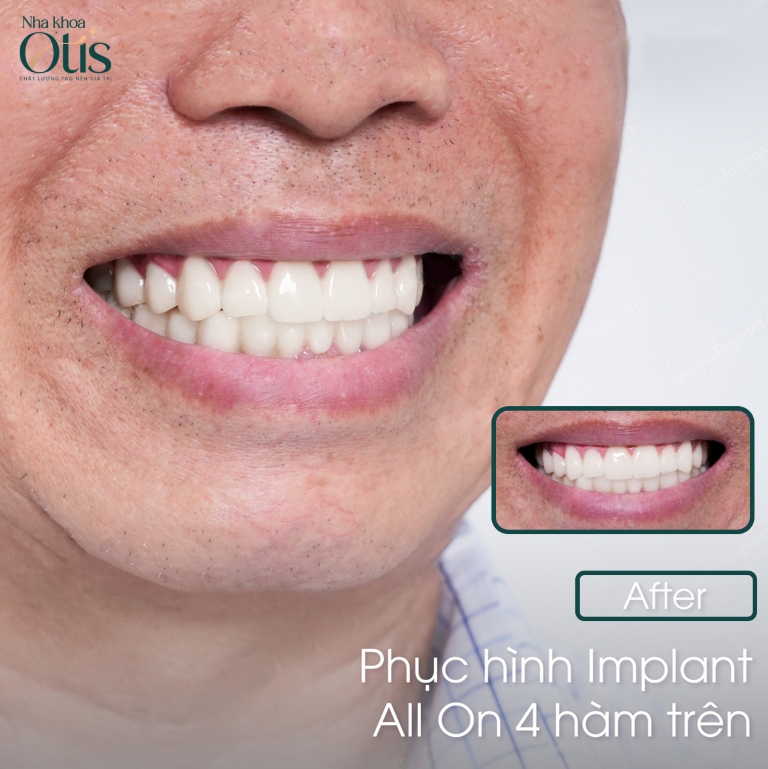 Sau trồng răng implant, răng chắc khỏe như răng thật