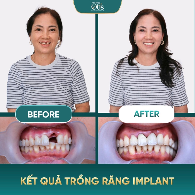 Trồng implant răng cửa cải thiện thẩm mỹ khuôn mặt