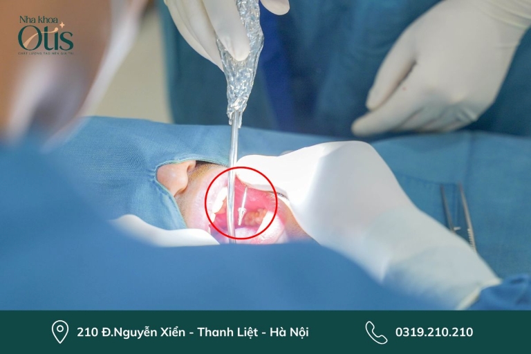 Trồng răng implant là giải pháp phục hình răng mất lâu năm