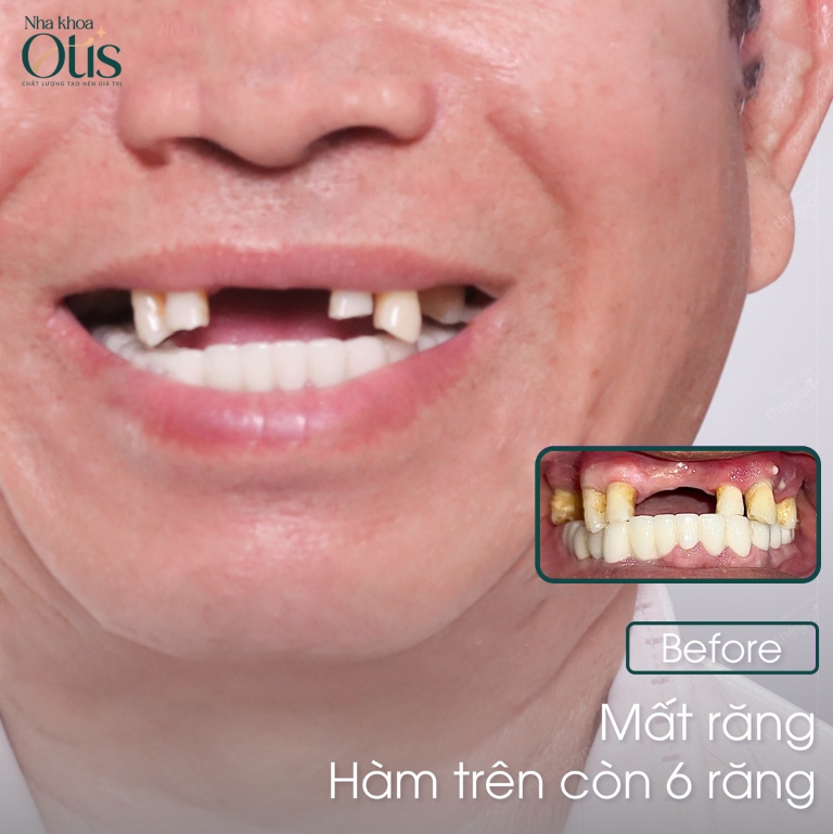 Mất răng lâu năm có trồng implant được không