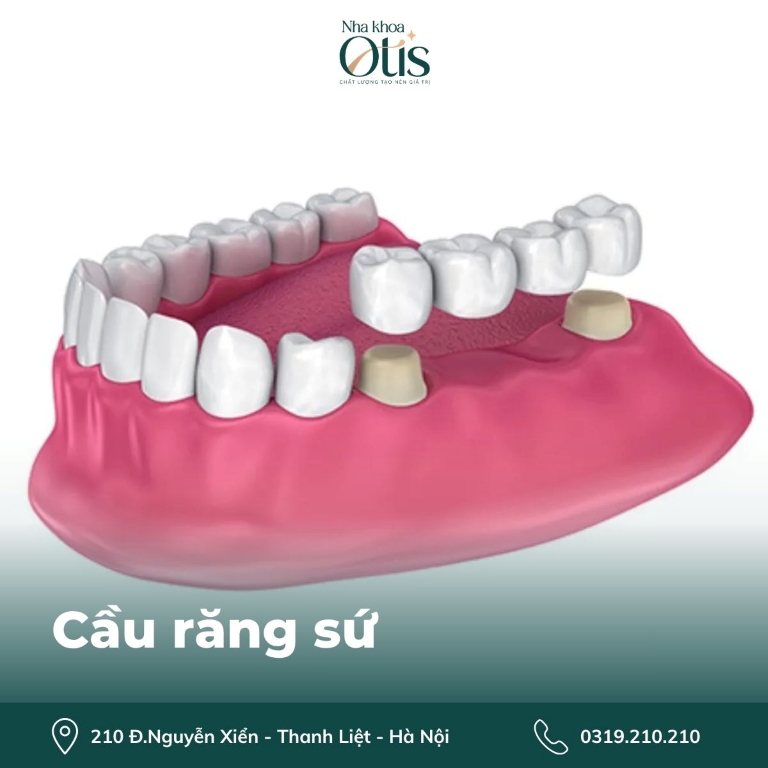 Làm cầu răng khi mất 1 răng hàm