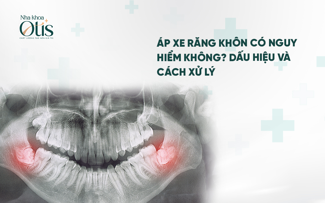 Áp xe răng khôn nguy hiểm như thế nào?