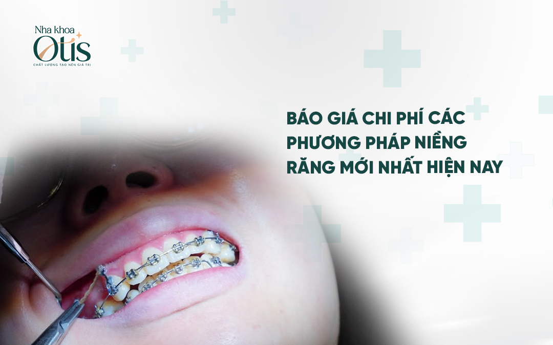 Báo giá chi phí các loại niềng răng