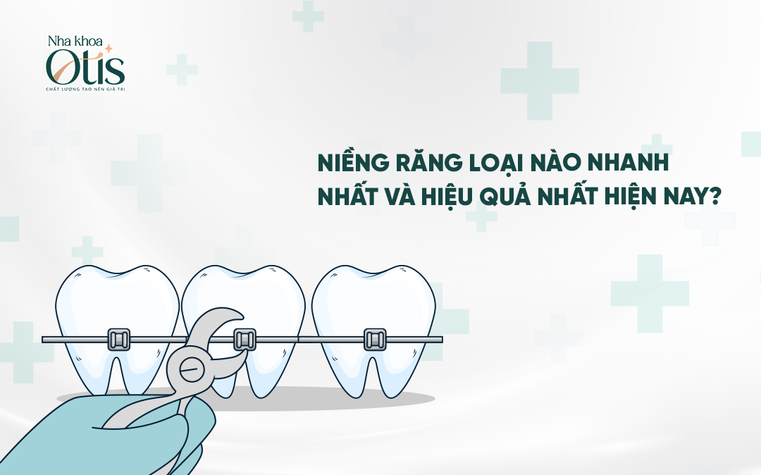 Niềng răng loại nào nhanh nhất