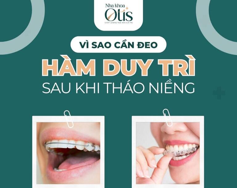 Kết thúc quy trình niềng răng là giai đoạn đeo hàm duy trì