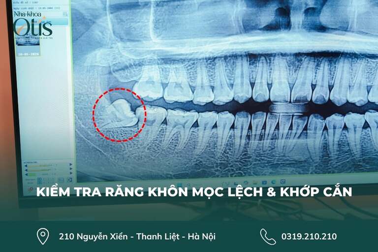 Răng khôn mọc lệch cần nhổ sớm