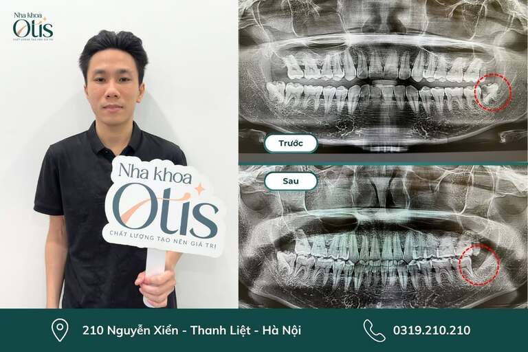 Trước khi nhổ răng khôn cần chụp phim CT 3D 