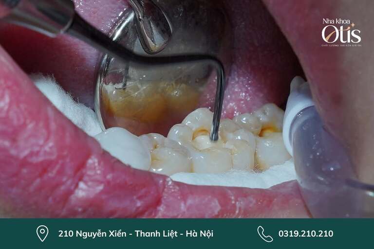 Xử lý các vấn đề tiền chỉnh nha
