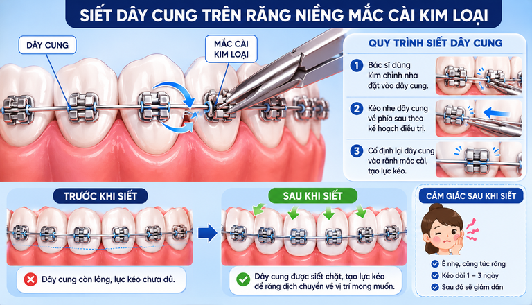 Niềng răng mắc cài kim loại sẽ hơi ê nhẹ trong giai đoạn siết răng