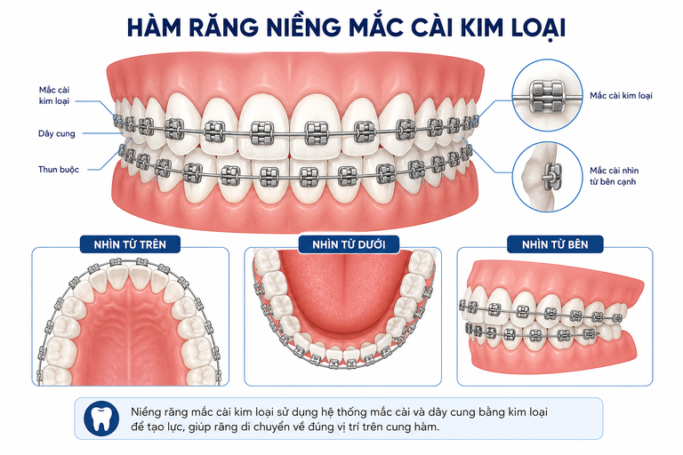 Niềng răng mắc cài kim loại không quá đau