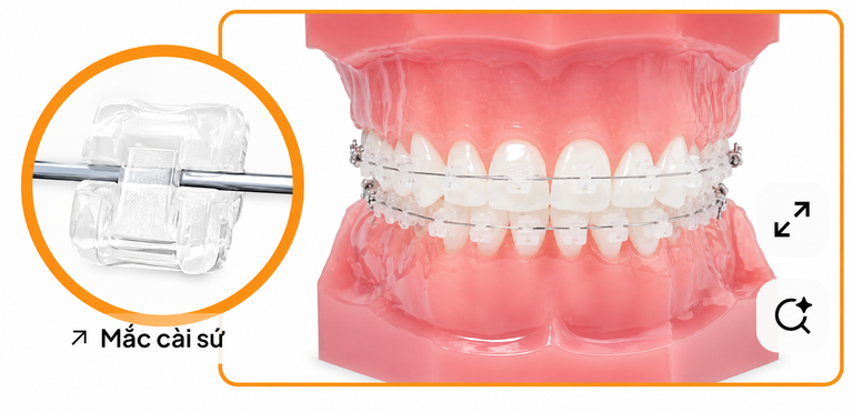 Niềng răng mắc cài sứ