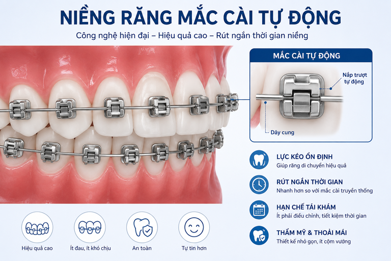 Niềng răng mắc cài kim loại tự động được đánh giá nhanh nhất