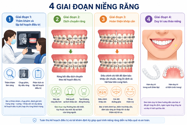 Các giai đoạn trong quy trình niềng răng