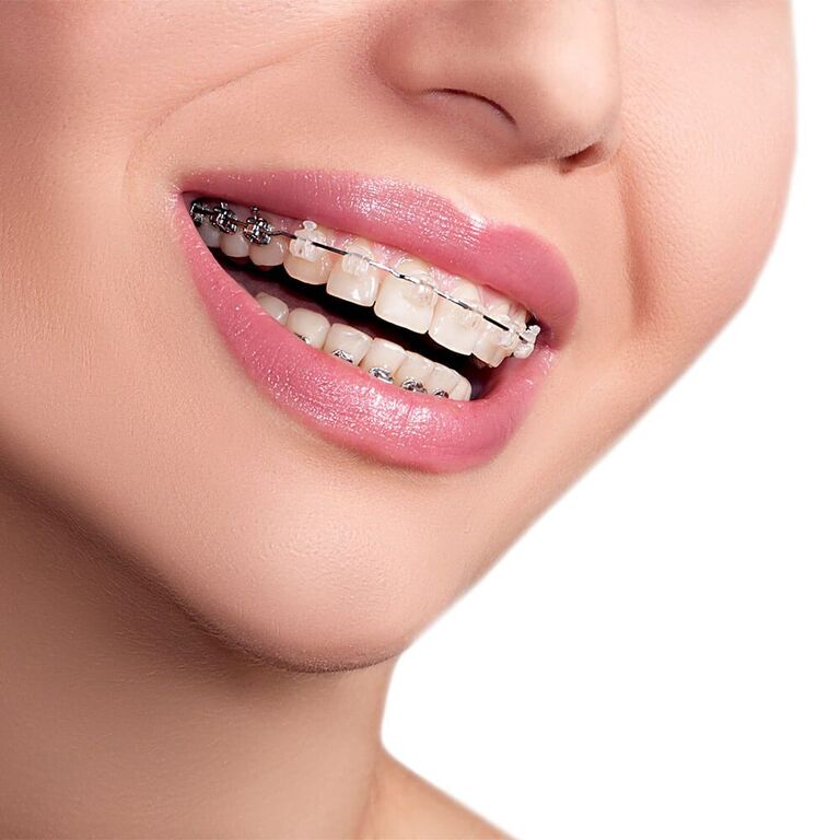 Niềng răng mắc cài sứ