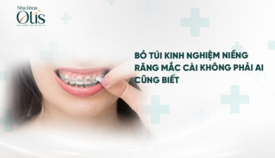 Kinh nghiệm niềng răng mắc cài cho người mới bắt đầu