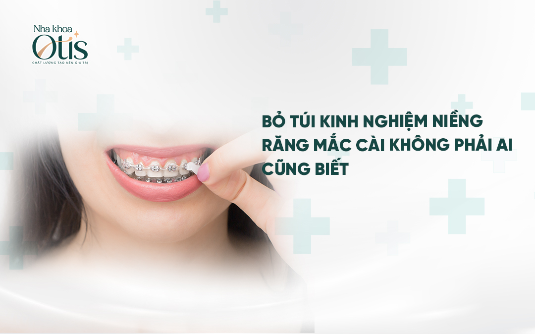 Kinh nghiệm niềng răng mắc cài cho người mới bắt đầu