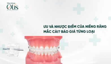 Niềng răng mắc cài là gì? Ưu và nhược điểm