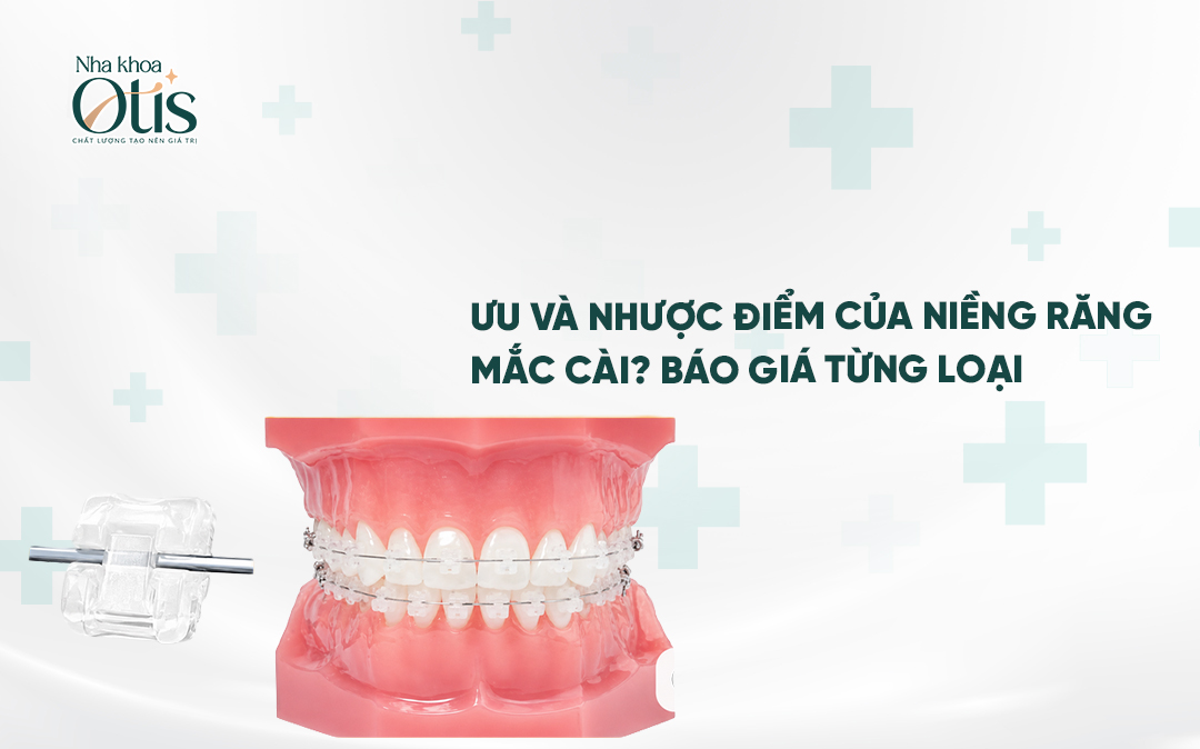 Niềng răng mắc cài là gì? Ưu và nhược điểm