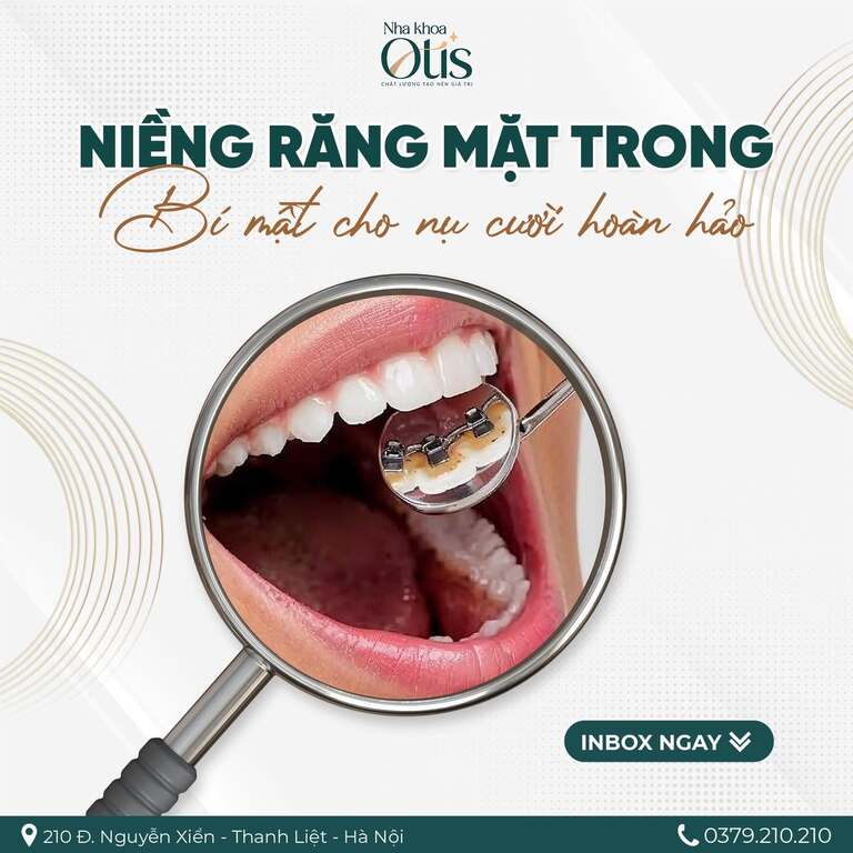 Mắc cài mặt lưỡi