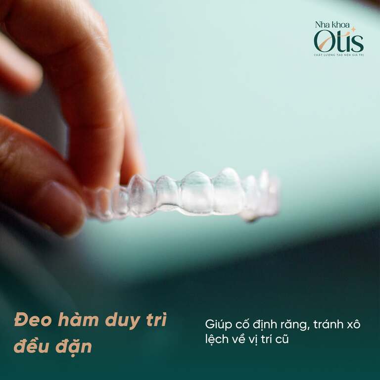 Đeo hàm duy trì sau khi xong lộ trình niềng răng mắc cài