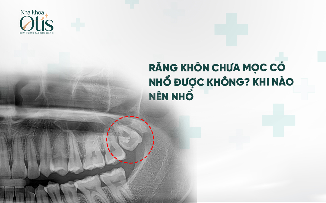 Răng khôn chưa mọc vẫn có thể nhổ được