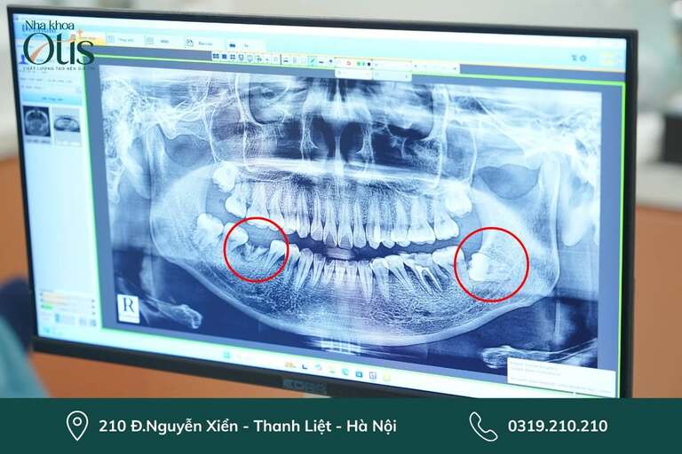 Răng khôn mọc ngầm cần nhổ sớm tránh ảnh hưởng