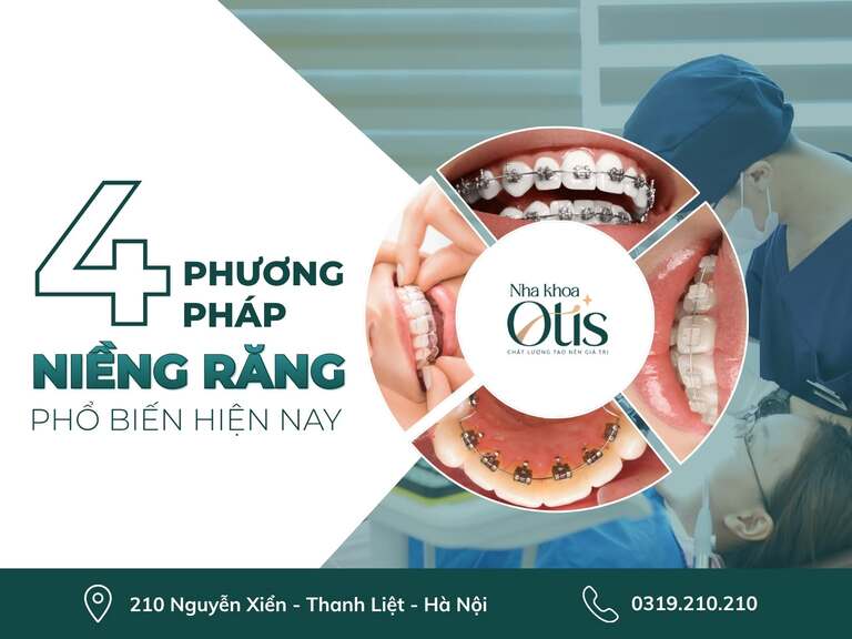 Những điều cần biết về niềng răng với các kỹ thuật khác nhau