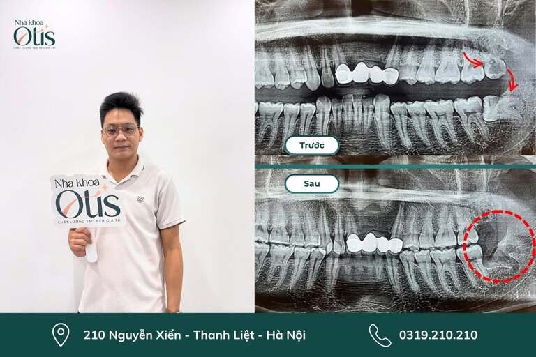 Chụp phim CT để kiểm tra sau nhổ răng khôn
