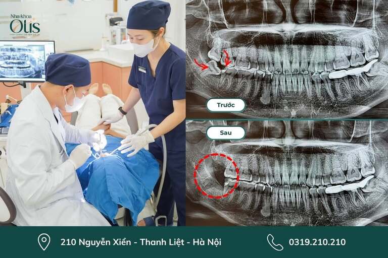 Nhổ 2 răng khôn cùng lúc rút ngắn thời gian