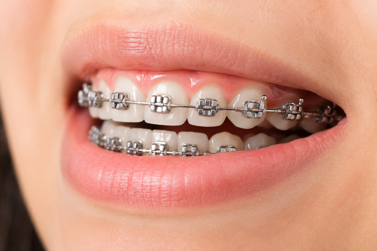 Niềng răng mắc cài kim loại có thể gây ê ức không quen