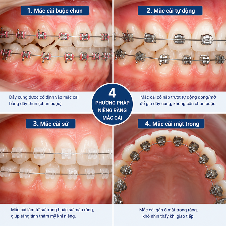 4 loại niềng răng mắc cài