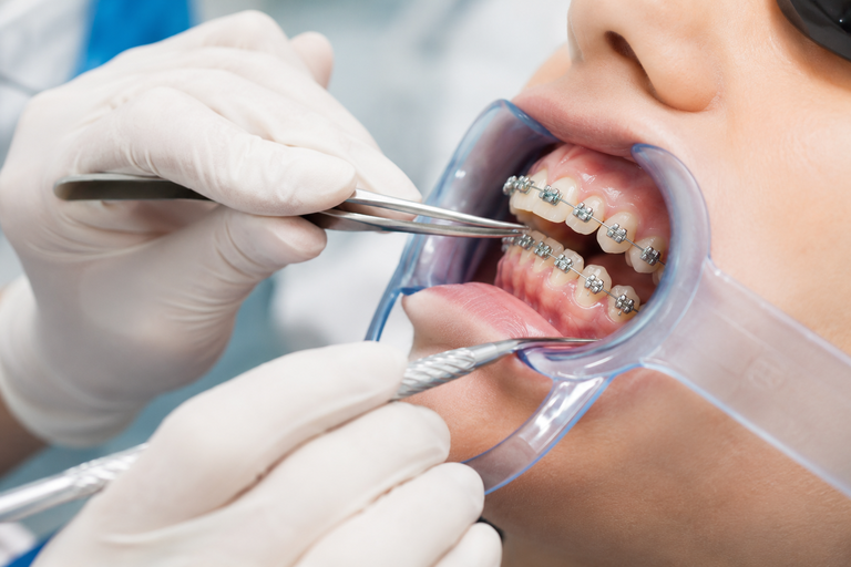 Bước gắn mắc cài trong quy trình niềng răng mắc cài