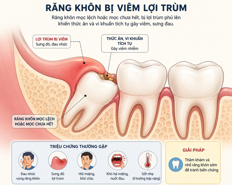 Răng khôn bị viêm lợi trùm cần nhổ sớm