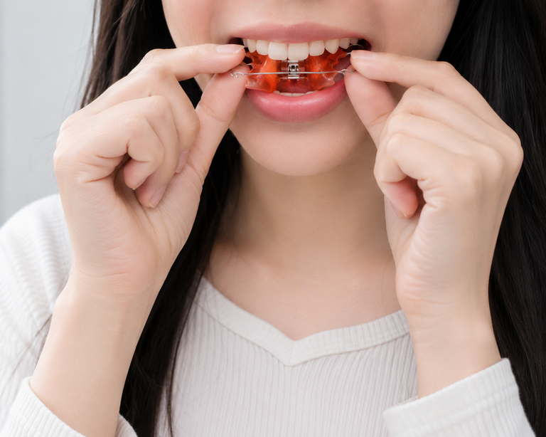 Sau niềng răng mắc cài cần đeo hàm duy trì