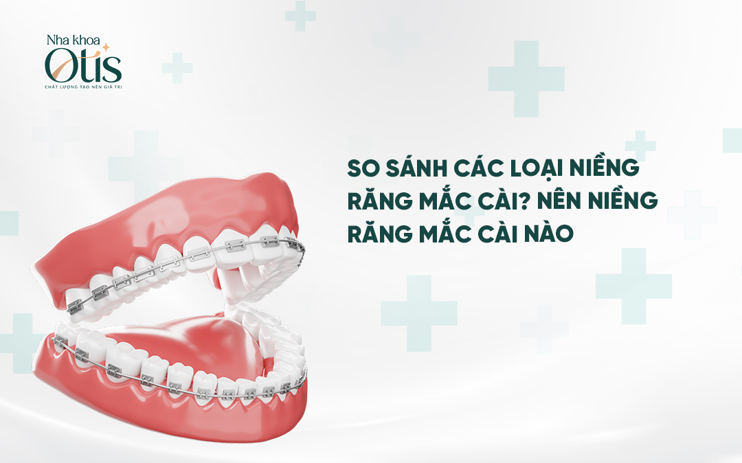 So sánh các loại mắc cài niềng răng