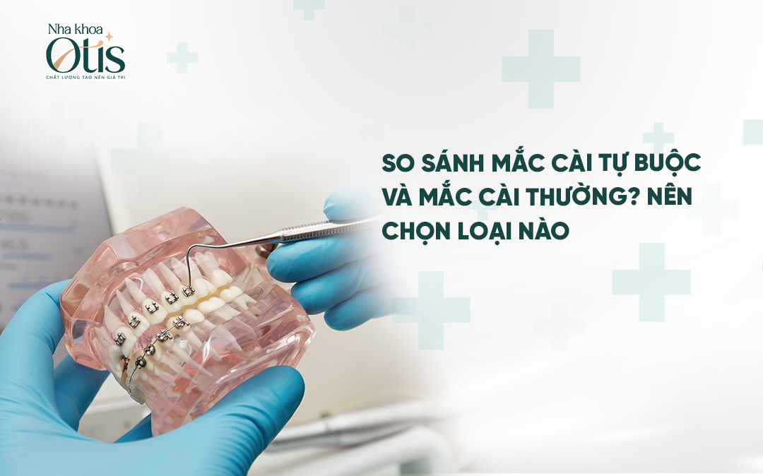 Mắc cài tự buộc và mắc cài thường nên chọn loại nào