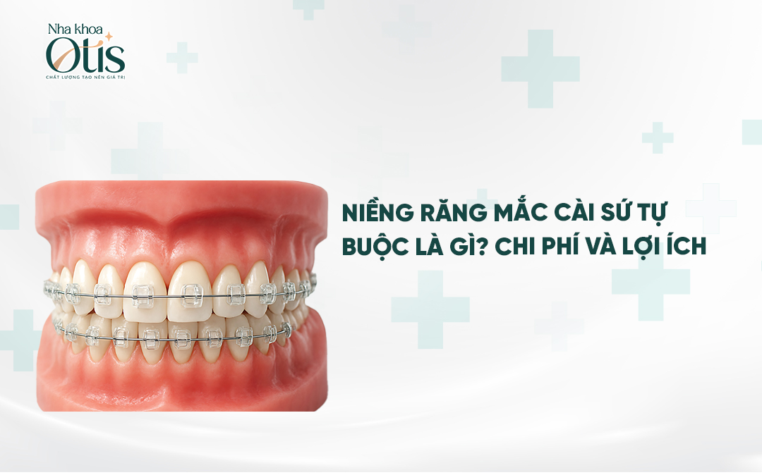 Báo giá niềng răng mắc cài sứ tự buộc