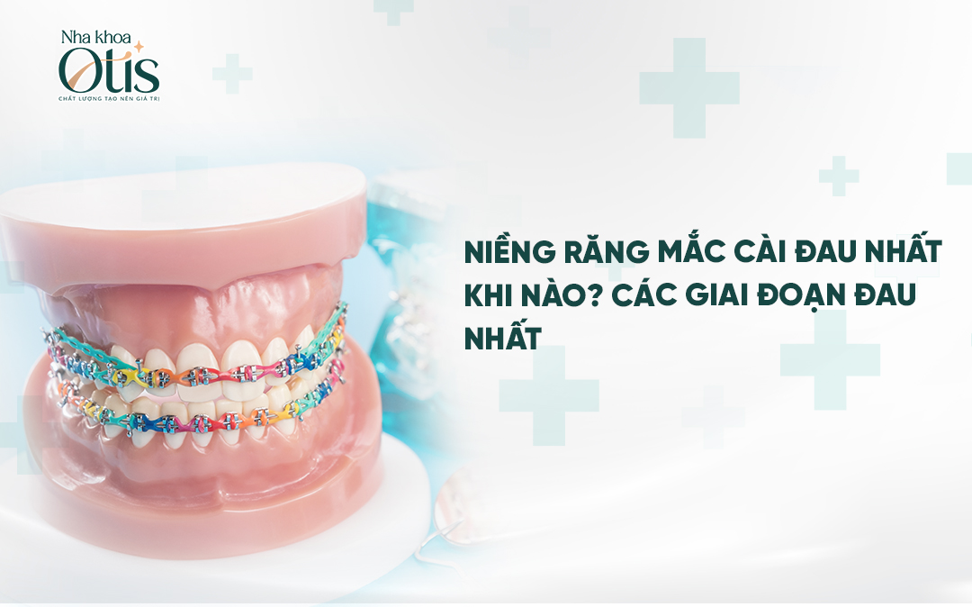 Niềng răng mắc cài đau nhất khi nào