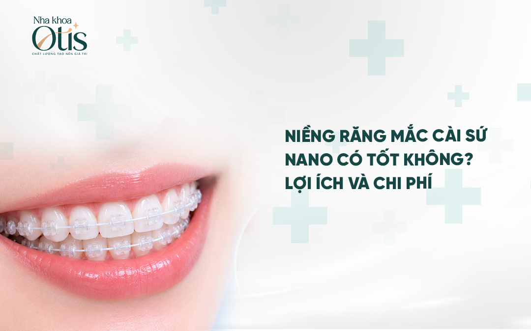 Niềng răng mắc cài sứ nano là gì