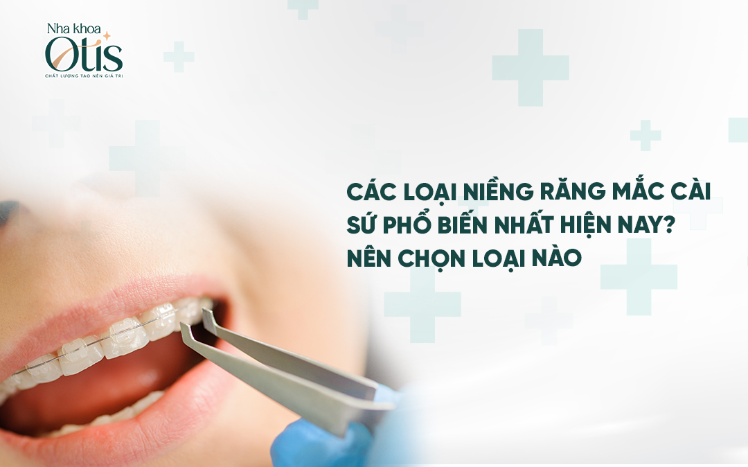 Nên lựa chọn các loại niềng răng mắc cài sứ nào