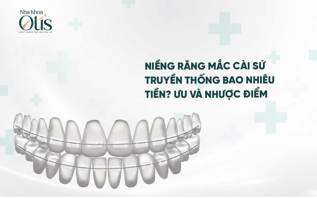 Ưu và nhược điểm niềng răng mắc cài sứ truyền thống