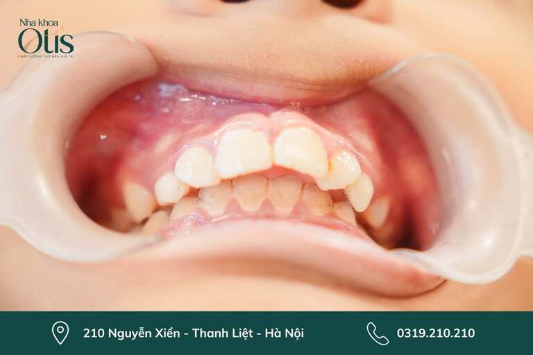 Răng hô cần niềng răng mắc cài bằng titan