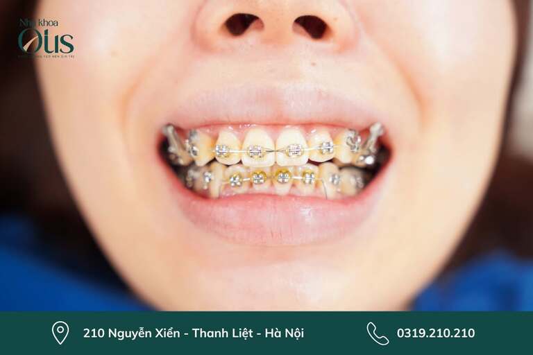 Niềng răng mắc cài titan khó vệ sinh răng