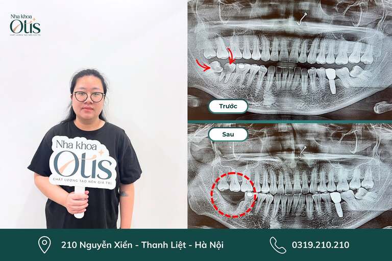Niềng răng có cần nhổ răng khôn nếu răng khôn mọc phức tạp và ảnh hưởng