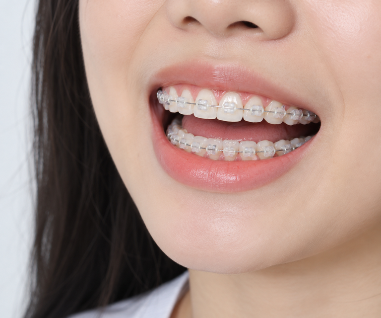 Niềng răng mắc cài sứ truyền thống có tính thẩm mỹ cao