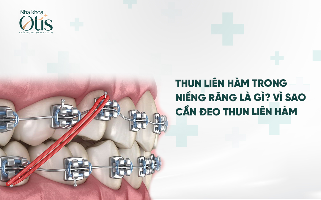 Khi nào cần đeo thun liên hàm niềng răng