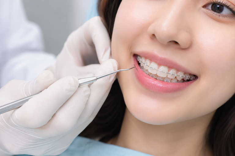 Niềng răng mắc cài sứ có đau không