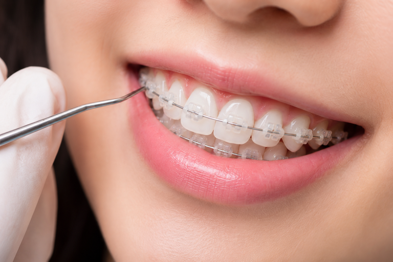 Mắc cài chất liệu sứ thường ít gây đau khi cọ sát với mô mềm