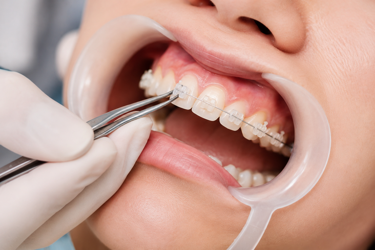Gắn mắc cài sứ trong quy trình niềng răng mắc cài sứ