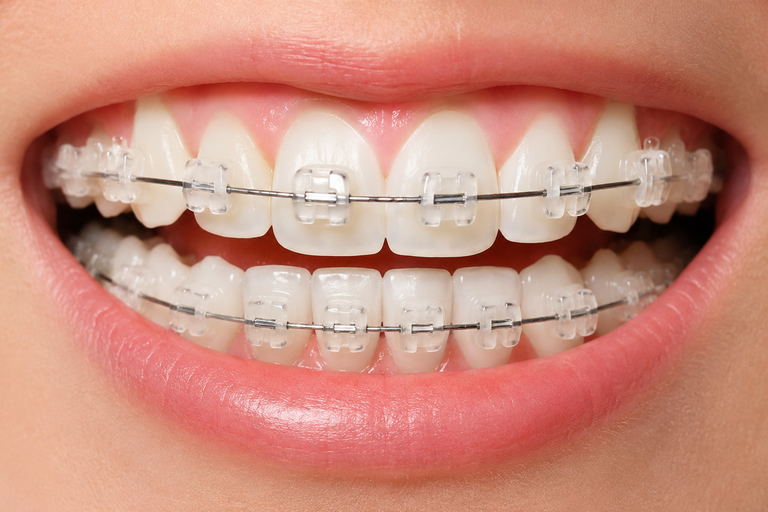 Niềng răng mắc cài sứ tự buộc